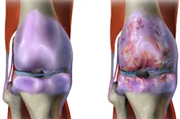 Arthritis or Joint Pain? Do This Immediately (Watch Results in 4 Days)